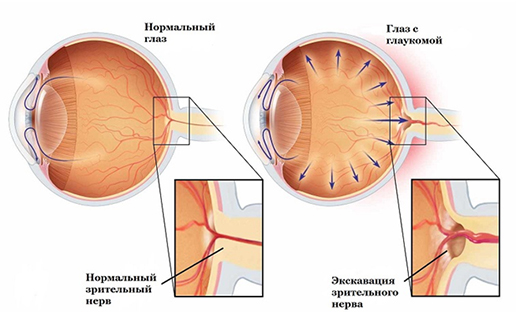 Операция глаукомы