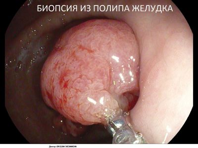 Биопсия из полипа желудка